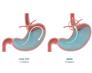 GERD Treatment in Fort Collins & Greeley, CO | Esophageal Disorders